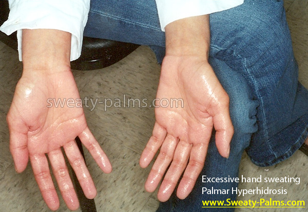 An example of sweaty palms