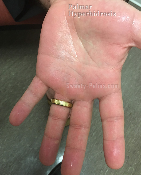 What are some simple cures for sweaty palms?