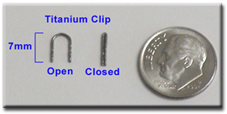 titanium clip - hyperhidrosis